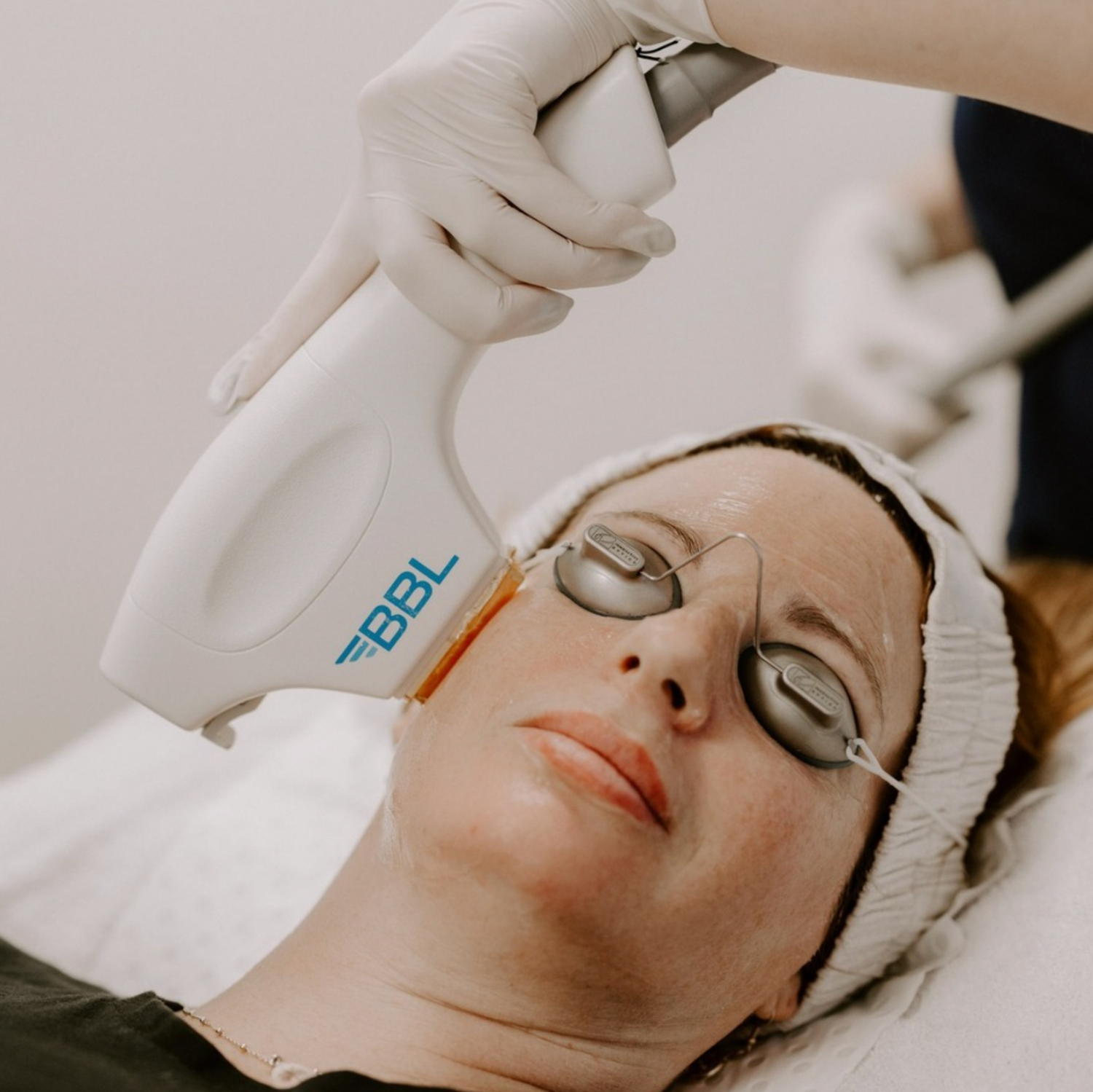 The Ultimate Guide to Reversing Sun Damage:  Evidence-Based Moxi & BBL Laser Treatments for Lasting Result